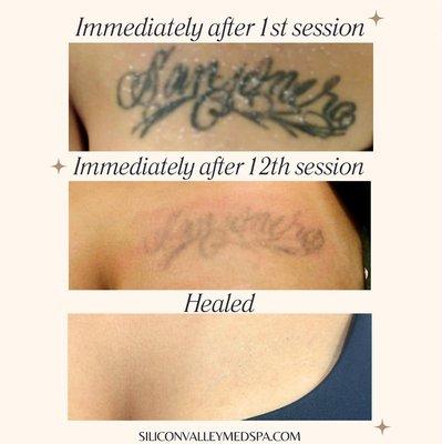 Just one of our great results from our #tattooremoval laser treatment
Call us for more questions! 408-620-1679