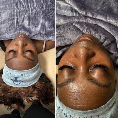 Before and after Hydrating facial!