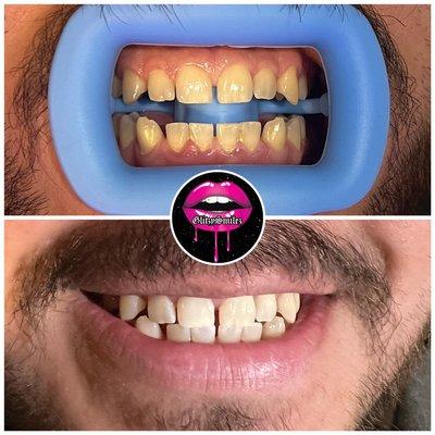 Teeth whitening