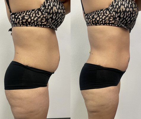 Laser lipo before and after!