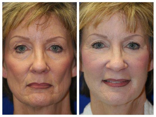 Fat Grafting Before and After Results by Haven J. Barlow, MD, FACS