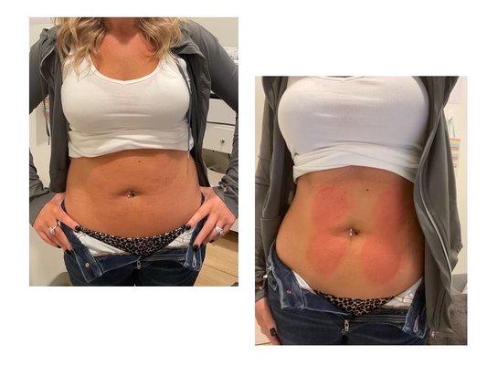 Before and After 1 STAR Sculpt treatment