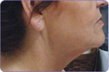 http://www.transformationsskincenter.com/Gallery.php - After 2 sessions laser treatment.  See before and after pictures