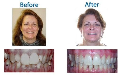 Invisalign Before and After Pictures