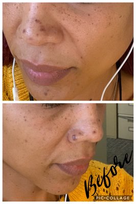 Before 1st Microdermabrasion treatment  After 1st Microdermabrasion treatment