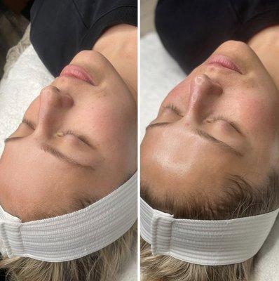 Hydro Facial