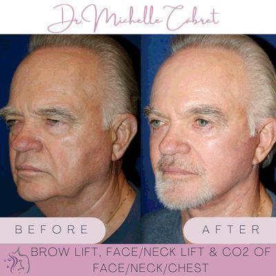 Face/Neck lift, Brow lift & C02 laser done by Dr. Michelle Cabret at The Cosmetic Center at DC Ranch in Scottsdale AZ