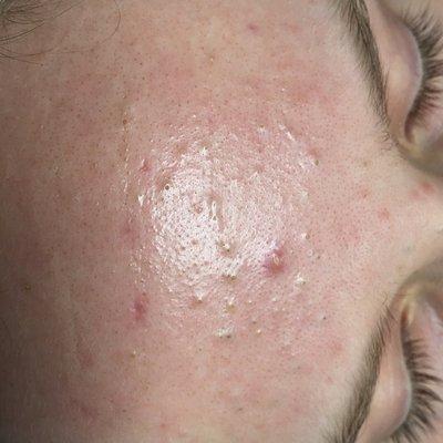 pre-acne treatment black heads, white heads, pustules