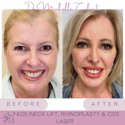 Face/Neck lift, Rhinoplasty & C02 laser done by Dr. Michelle Cabret at The Cosmetic Center at DC Ranch in Scottsdale AZ