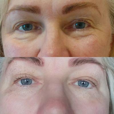 Plasmalift eyelid lift at Lakeside Skincare!