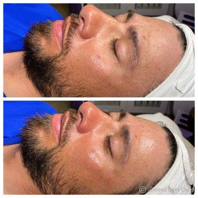 Microdermabrasion + Chemical Peel