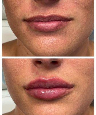 Lip filler before and after