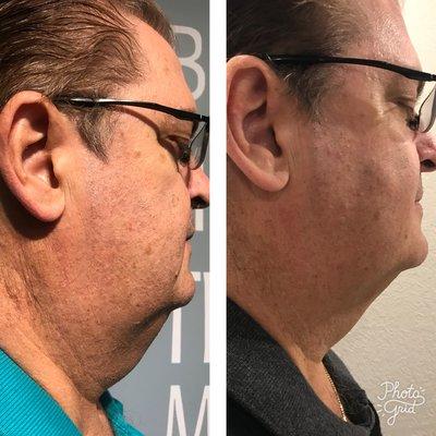 Eliminate your double chin painlessly! These results were after only 5 sessions