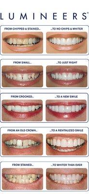 Veneers ! Call For your free consultation 305.227.5888