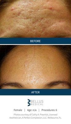 MicroNeedling