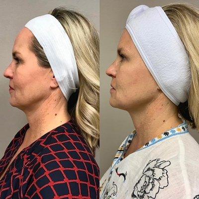 Before and after 6 Accent Skin Tightening Laser on neck