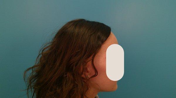 1 year post 3 PRP treatments Alopecia Areata