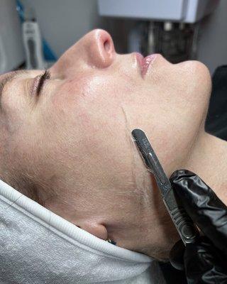 Dermaplaning