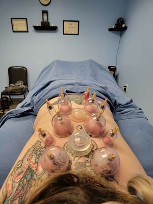 Me getting cupping.(really good for migraines!!)