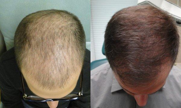 PRP Hair Restoration