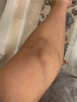 Blood work bruise