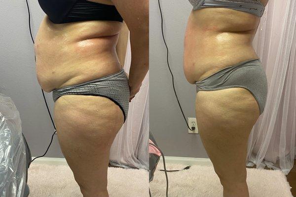 2 sessions of 1 Hour Non Invasive Lipo Cavitation