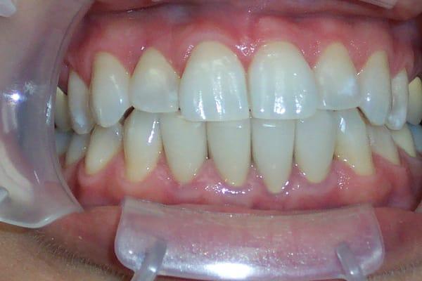 40 Year Old Female after Invisalign and Whitening for Life.