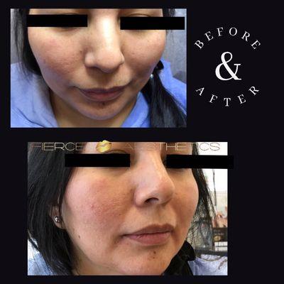 Non-Surgical Nose Job