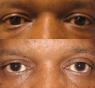 Before and After!  48-Year-­Old Male Upper & Lower Eyelid Procedures