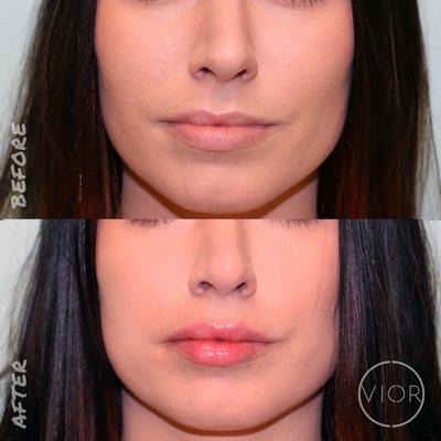 Minor lip augmentation