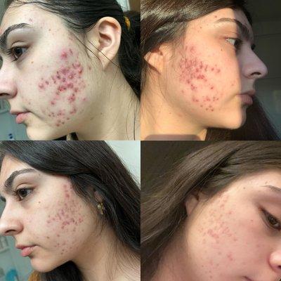 ACNE boot camp client before &after