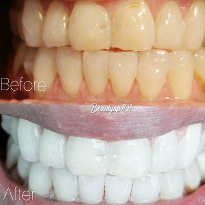 We offer Teeth whitening services. Call 956-444-0002