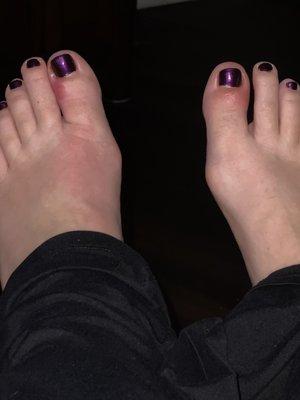 Both big toes