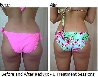 Reduxx Liporeduction & Body Contouring Centers