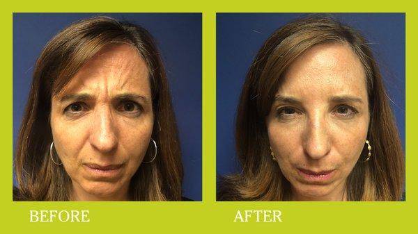 Botox and fillers before and after in a woman in her 40's.