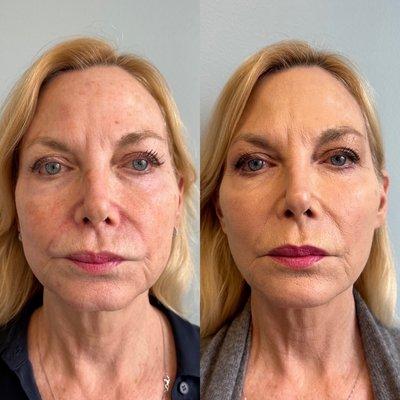 Derma Filler to chin, cheeks and jawline