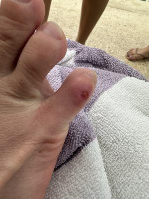 Blisters caused by water shoes