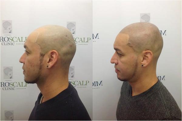 Micro Scalp Clinic  http://www.microscalpclinic.com/