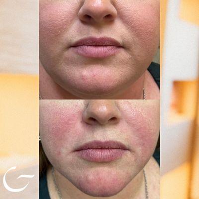 Before + After | Juvederm Filler 
*
Unlock the beauty of facial balancing with Juvederm Filler