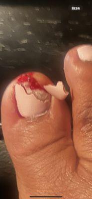 Big toe cracked