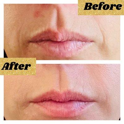 Fillers: Before and After