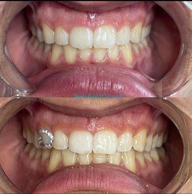 Teeth Whitening: Before & After