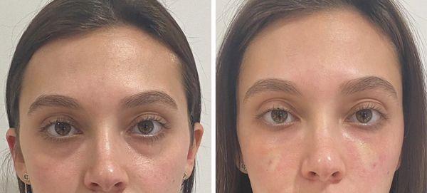 Undereye Filler