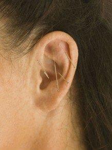 Auricular Therapy