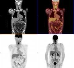 Axumin PET/CT Scan for Prostate Recurrence - NEW!