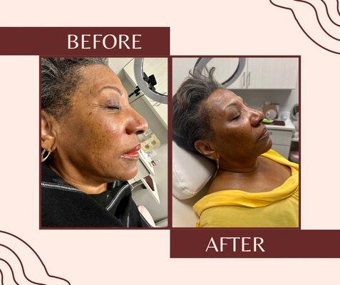 Microneedling with PRP- 2 sessions