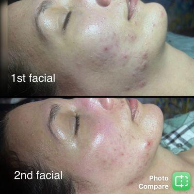 Kicking acnes butt 1 facial at a time!