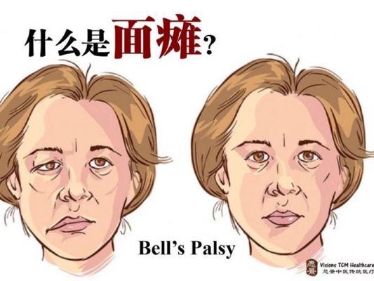 acupuncture  healing Bell's Palsy