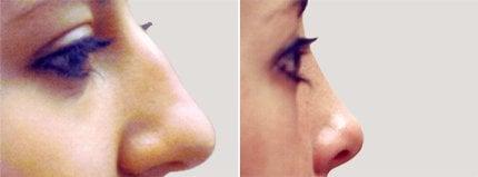 Rhinoplasty Procedures in Toledo