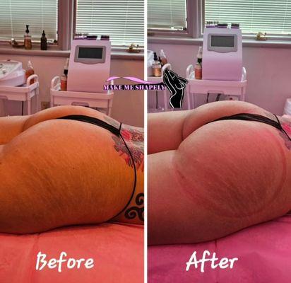 Non-invasive Brazilian butt lift